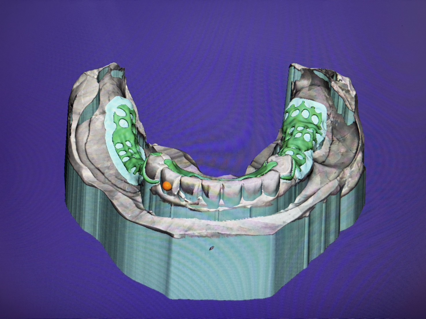 デジタル機器を使用した入れ歯のバネ作製