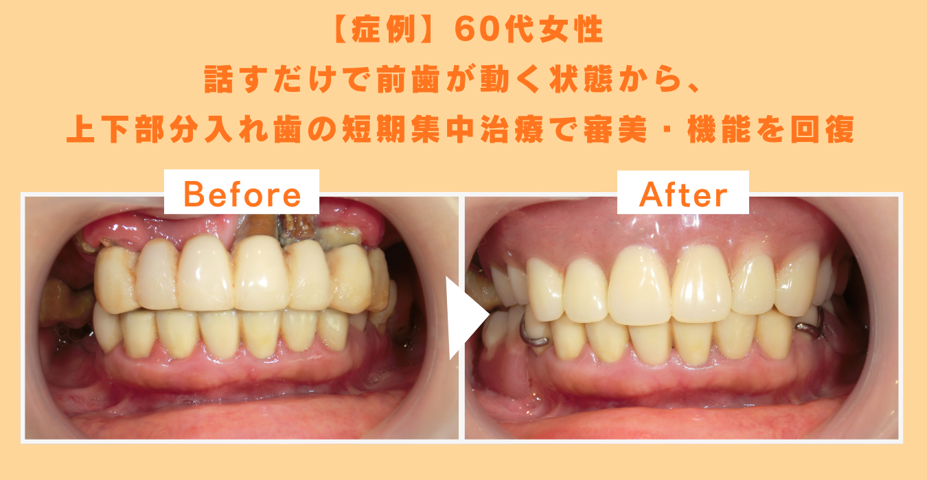 審美入れ歯を入れる前と後のビフォーアフター画像、歯周病がひどい術前からきれいな前歯に