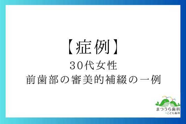 「症例」30代女性前歯部の審美的補綴の一例アイキャッチ画像