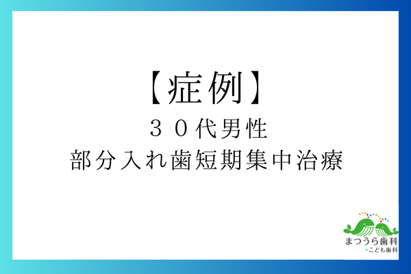 【症例】30代男性の部分入れ歯短期集中治療アイキャッチ画像