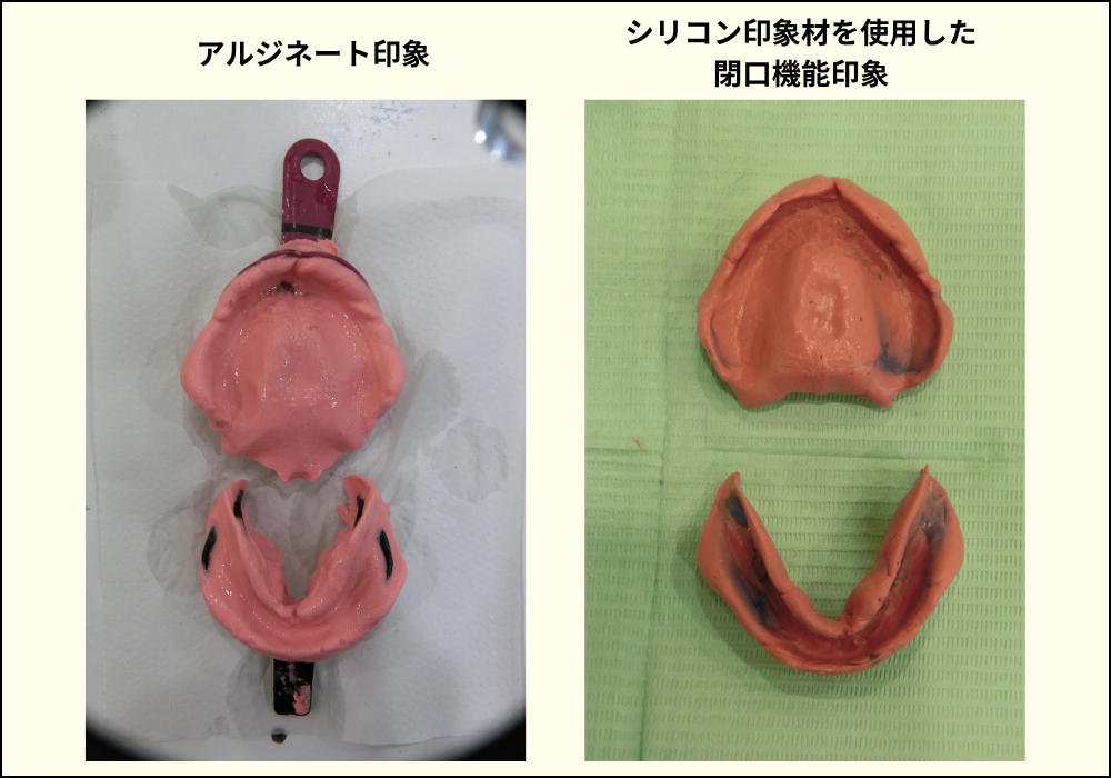 アルジネート印象とシリコン印象材を使用した閉口機能印象を左右に並べた比較画像