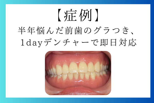 半年悩んだ前歯のグラつき、1dayデンチャーで即日対応した症例