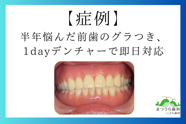 半年悩んだ前歯のグラつき、1dayデンチャーで即日対応アイキャッチ画像