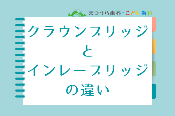 クラウン（全部被覆冠）のブリッジとインレーブリッジの違いアイキャッチ画像