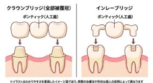 クラウンブリッジ（全部被覆冠）とインレーブリッジで支台歯を削る範囲の違いを示した比較イラスト