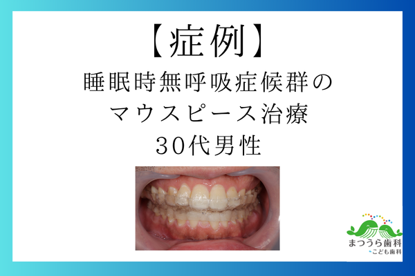 [症例]睡眠時無呼吸症候群のマウスピース治療 30代男性