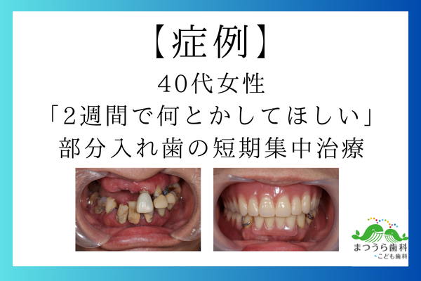 「2週間で何とかしてほしい」部分入れ歯の短期集中治療｜40代女性