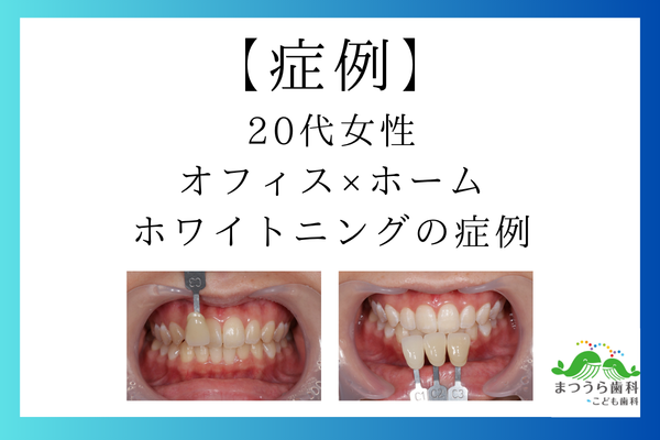 20代女性｜オフィス×ホームホワイトニングの症例