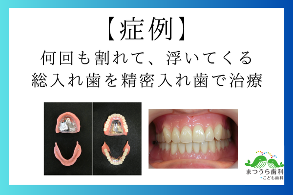 【症例】 何回も割れて、浮いてくる 総入れ歯を精密入れ歯で治療