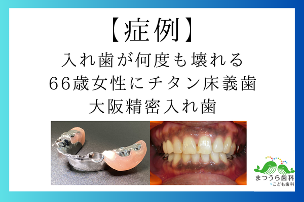 入れ歯が何度も壊れる66歳女性にチタン床義歯｜大阪精密入れ歯