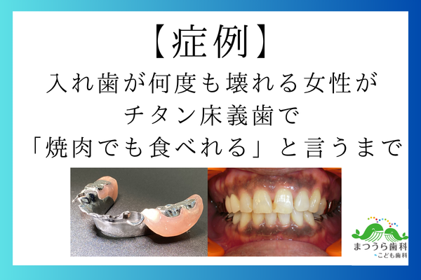 【症例】 入れ歯が何度も壊れる女性が チタン床義歯で 「焼肉でも食べれる」と言うまで