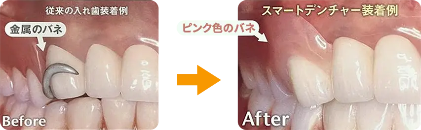見た目にも配慮したノンメタルクラスプデンチャーという選択肢も！